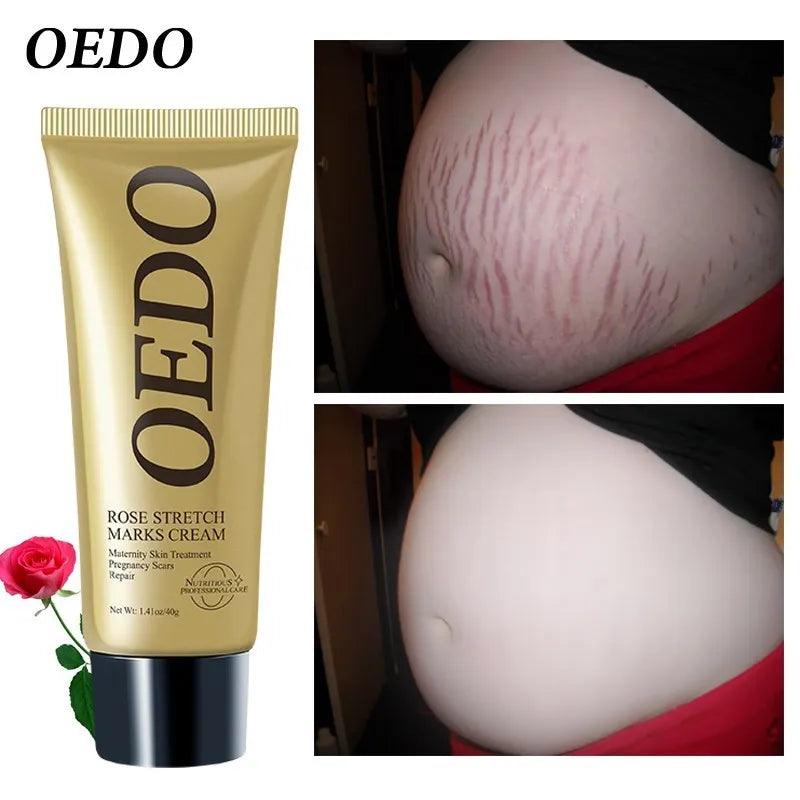 Rose Removes Stretch Mark Cream